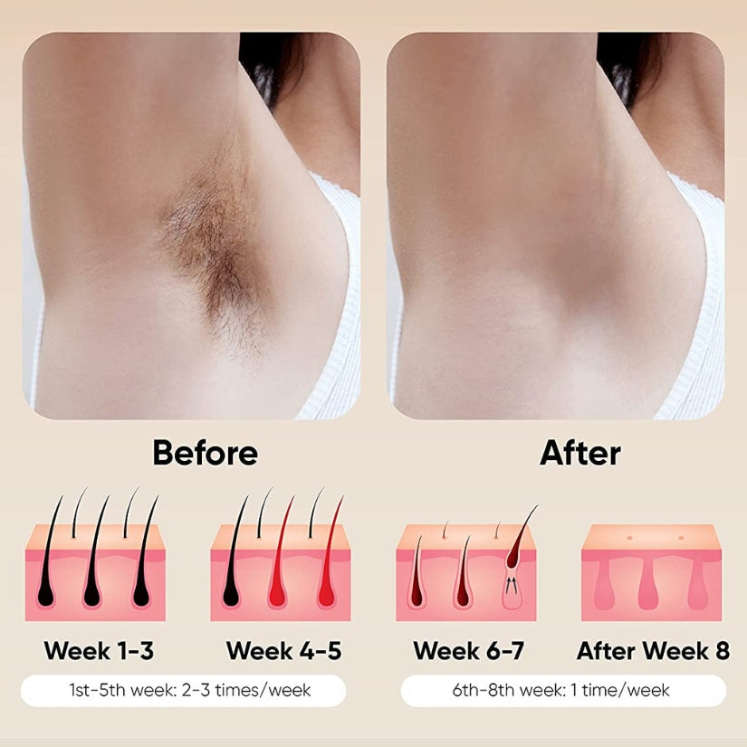 IPL Hair Removal Haven