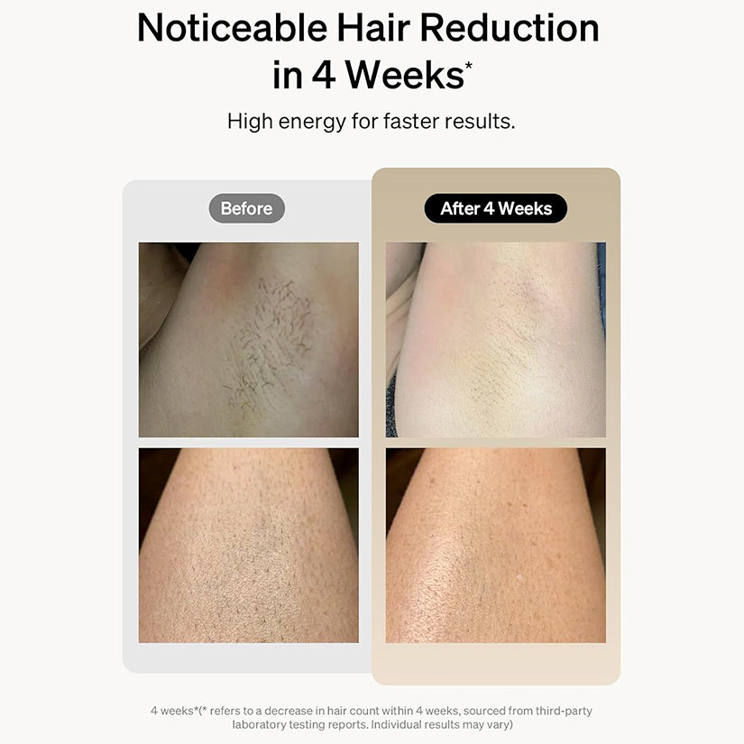 IPL Hair Removal Haven